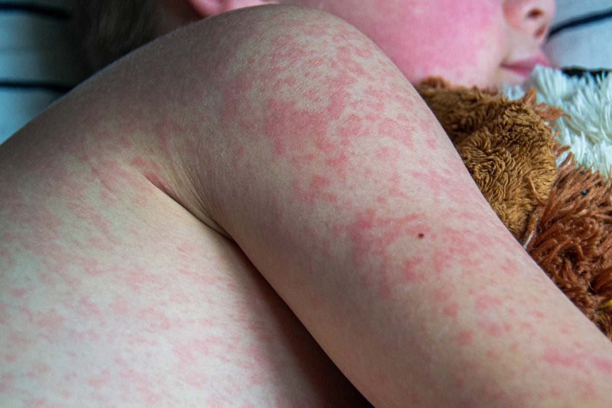 Waspada Campak pada Anak, Awalnya Mirip Flu