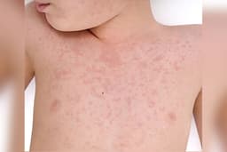 RSUD Pandega Pangandaran Ingatkan Waspada Campak, Imunisasi MR Penting untuk Anak